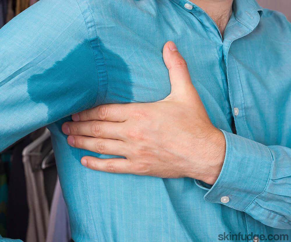 Hyperhidrosis Clinic - SKINFUDGE Aesthetics | Painless, No Side Effects, Natural Looking Results