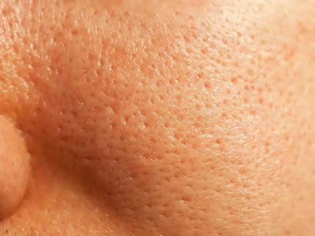 Open Pores Treatment - SKINFUDGE Aesthetics | Painless, No Side Effects, Natural Looking Results