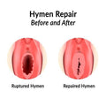 Hymen Repair (Hymen Reconstruction Surgery) - SKINFUDGE Aesthetics | Painless, No Side Effects, Natural Looking Results