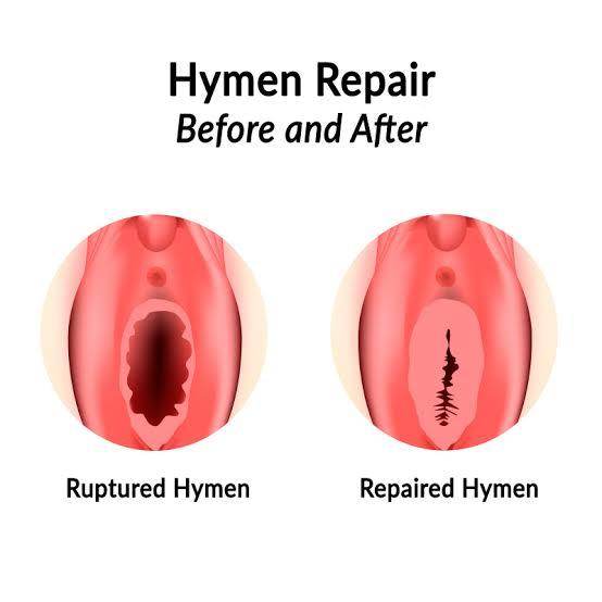 Hymen Repair (Hymen Reconstruction Surgery) - SKINFUDGE Aesthetics | Painless, No Side Effects, Natural Looking Results