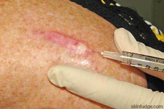 Intralesional Injections - SKINFUDGE Aesthetics | Painless, No Side Effects, Natural Looking Results