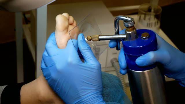 Liquid Nitrogen Cryotherapy Treatment for Warts - SKINFUDGE Aesthetics | Painless, No Side Effects, Natural Looking Results
