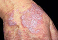Lichen Planus Treatment - SKINFUDGE Aesthetics | Painless, No Side Effects, Natural Looking Results
