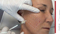 Mesotherapy Treatment - SKINFUDGE Aesthetics | Painless, No Side Effects, Natural Looking Results