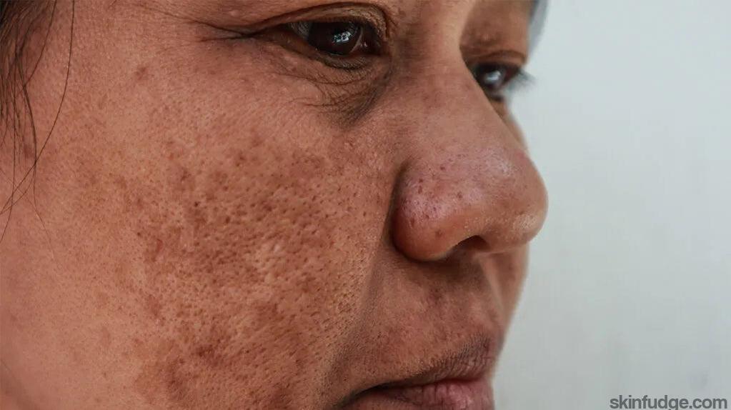 Melasma Treatment Consultation-SKINFUDGE