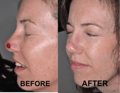 Mohs Micrographic Surgery - SKINFUDGE Aesthetics | Painless, No Side Effects, Natural Looking Results