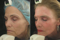 Non-surgical CO2 Fotona Facelift - SKINFUDGE Aesthetics | Painless, No Side Effects, Natural Looking Results