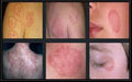 Tinea Corporis Treatment - SKINFUDGE Aesthetics | Painless, No Side Effects, Natural Looking Results