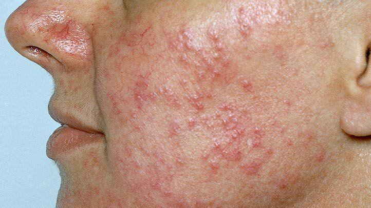Rosacea Treatment in Lahore-SKINFUDGE