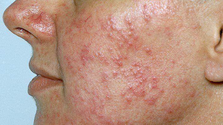 Rosacea Treatment in Lahore - SKINFUDGE Aesthetics | Painless, No Side Effects, Natural Looking Results
