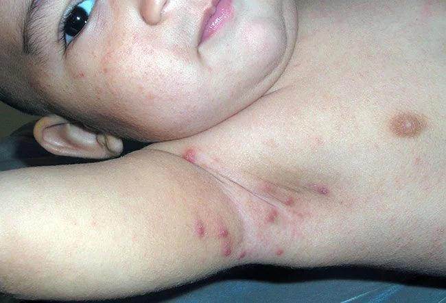 Scabies Consultation - SKINFUDGE Aesthetics | Painless, No Side Effects, Natural Looking Results
