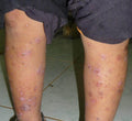 Scabies Consultation - SKINFUDGE Aesthetics | Painless, No Side Effects, Natural Looking Results
