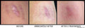 Self-Harm, Injury Marks Arm Scar Treatment with Fotona CO2 Laser - SKINFUDGE Aesthetics | Painless, No Side Effects, Natural Looking Results