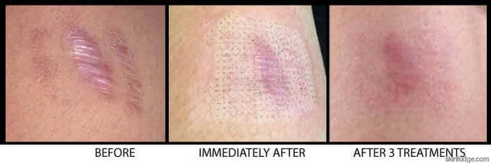 Self-Harm, Injury Marks Arm Scar Treatment with Fotona CO2 Laser-SKINFUDGE