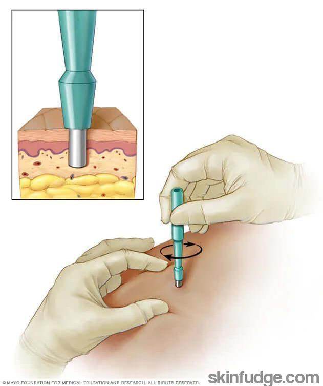 Skin Biopsy - SKINFUDGE Aesthetics | Painless, No Side Effects, Natural Looking Results