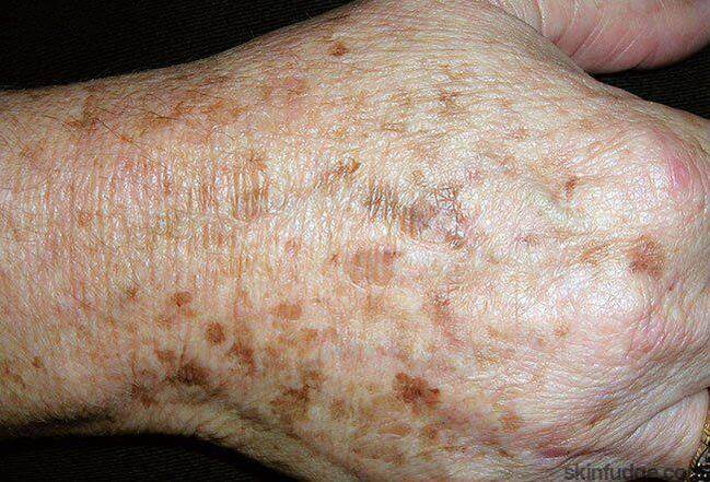 Sun Spots, Age Spots and other Pigmented Lesion Removal - SKINFUDGE Aesthetics | Painless, No Side Effects, Natural Looking Results