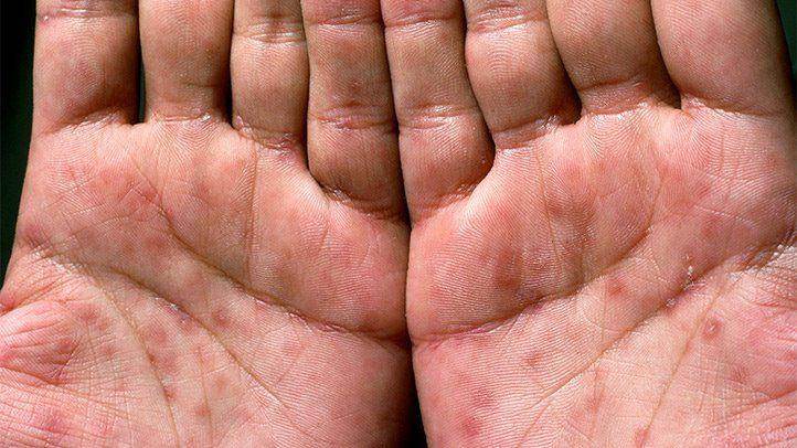Syphilis Treatment - SKINFUDGE Aesthetics | Painless, No Side Effects, Natural Looking Results