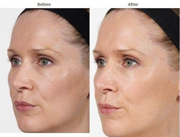 Temporal Filler - SKINFUDGE Aesthetics | Painless, No Side Effects, Natural Looking Results