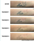 Tattoo Laser Removal - SKINFUDGE Aesthetics | Painless, No Side Effects, Natural Looking Results