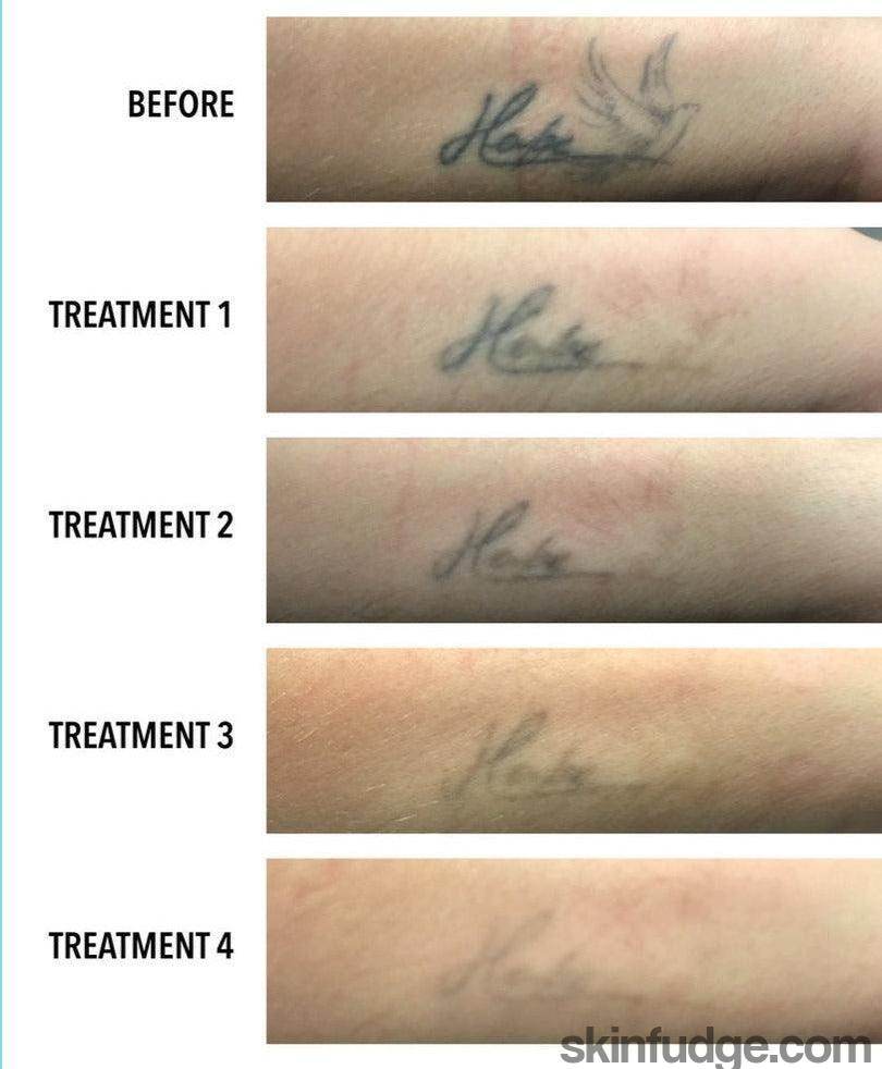 Tattoo Laser Removal - SKINFUDGE Aesthetics | Painless, No Side Effects, Natural Looking Results