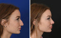 Piezoelectric rhinoplasty - SKINFUDGE Aesthetics | Painless, No Side Effects, Natural Looking Results